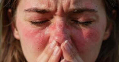 allergy induced facial redness