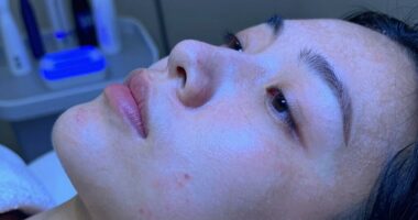 blue light treats acne