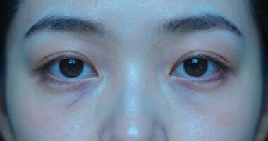 cold reduces swelling through vasoconstriction