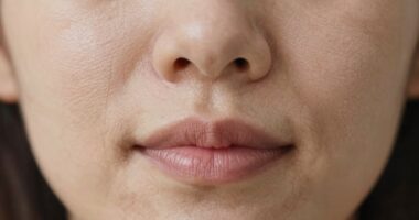 dehydration lines resemble wrinkles