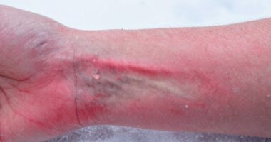 delayed skin redness response