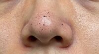 different treatments for blackheads