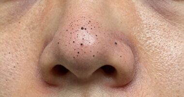 different treatments for blackheads