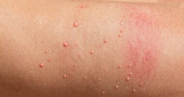 differentiating sauna skin reactions