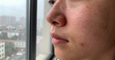 dry air exacerbates skin irritation