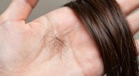 identify hair loss type