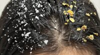 identifying scalp dryness dandruff