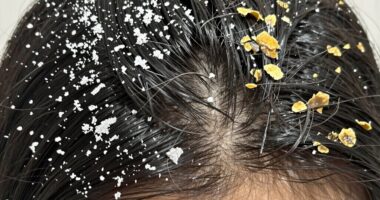 identifying scalp dryness dandruff