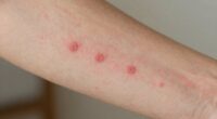 ipl and folliculitis risk