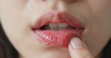 lip peeling and habits