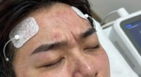 microcurrent headache triggers
