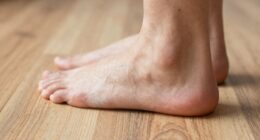 morning pain from plantar fasciitis