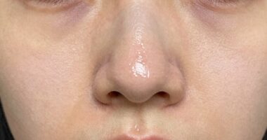 nose produces more oil