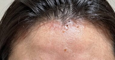 post wash scalp itching