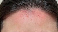 sensitive scalp reactions