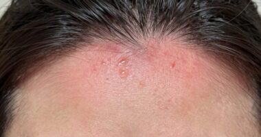 sensitive scalp reactions