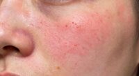 skin burning after mild treatment