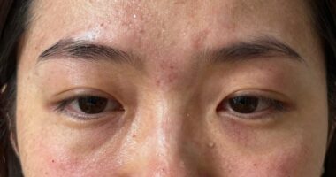 stress causes skin changes