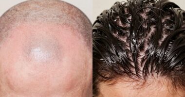 clean versus coated scalp
