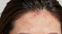 oily vs clogged scalp