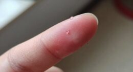 persistent mild stinging warning