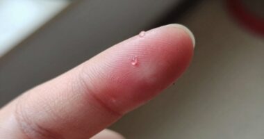 persistent mild stinging warning