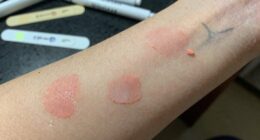 rushing causes patch test failures