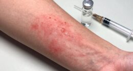 signs of worsening reaction