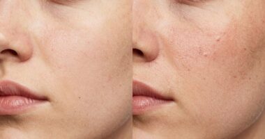 skin damage from excessive washing