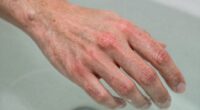 skin reaction to water