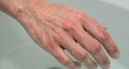 skin reaction to water