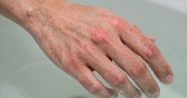 skin reaction to water
