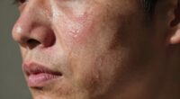 stress worsens skin texture
