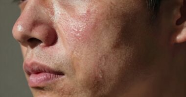 stress worsens skin texture
