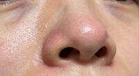 temporary pore size change