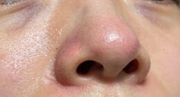 temporary pore size change