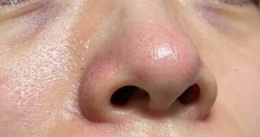 temporary pore size change