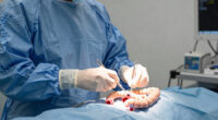 Small Bowel Perforation As An Initial Manifestation Of Immune Deficiency And Dysregulation-Associated Lymphoma In A Patient With Rheumatoid Arthritis: A Case Report